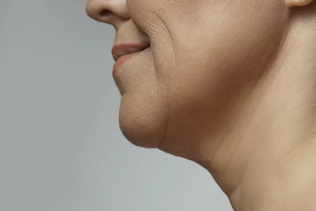 Injection to reduce a double chin