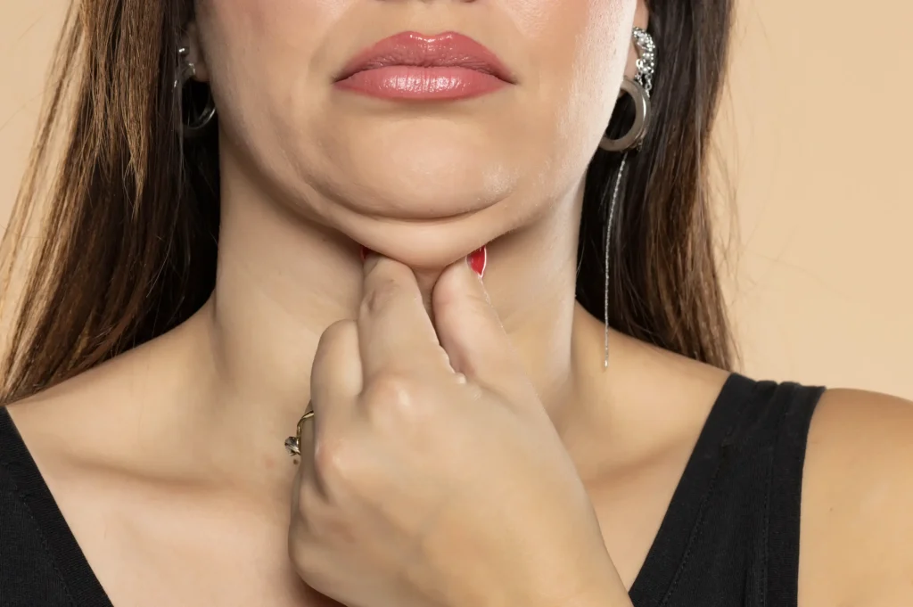 Double chin
