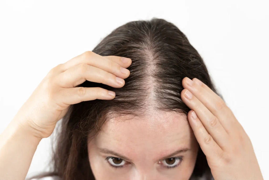 Hair loss