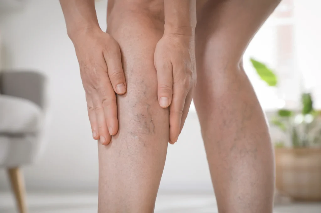 Varicose veins and spider veins