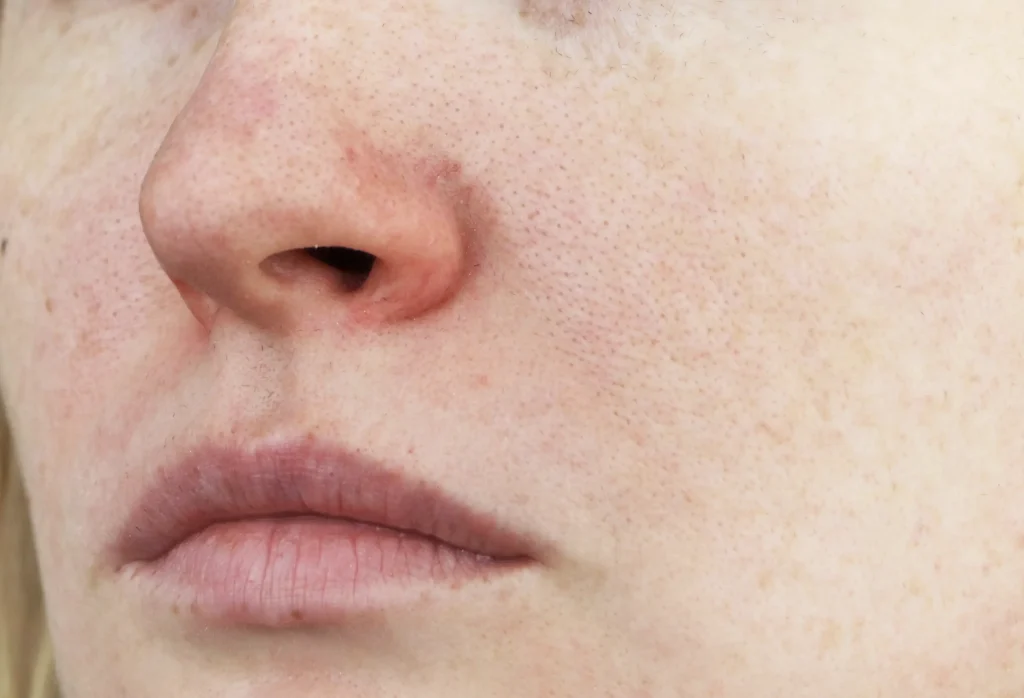 Facial veins and telangiectasias
