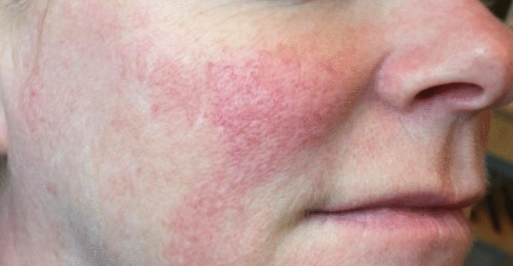 Vascular laser treatment