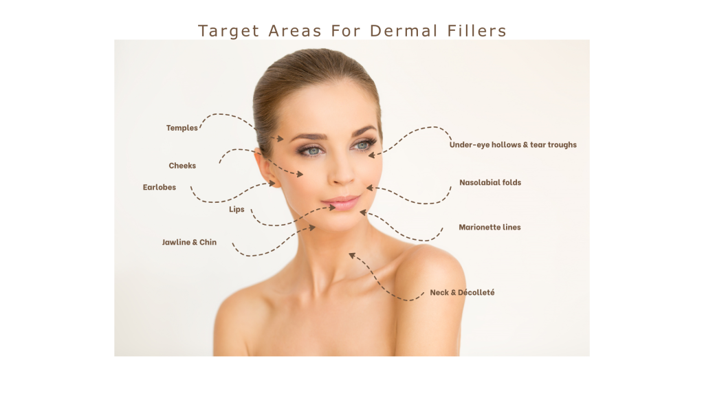 Facial areas treated with hyaluronic acid dermal fillers